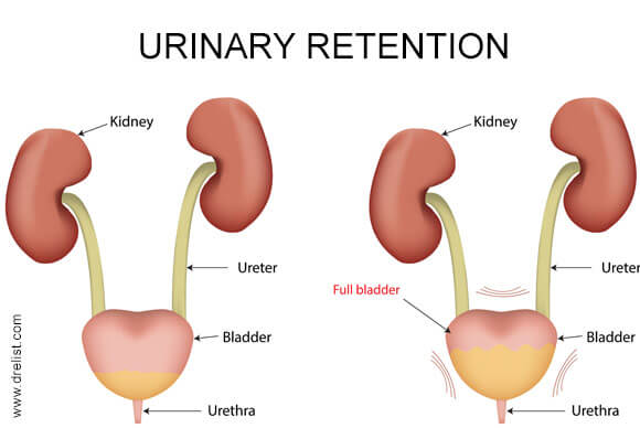 Acute urinary retention : causes , clinical features and patient care & art  & science continence focus